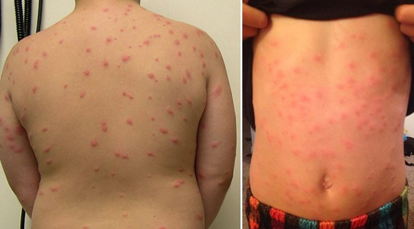 Шистосомний дерматит на шкірі спини і живота